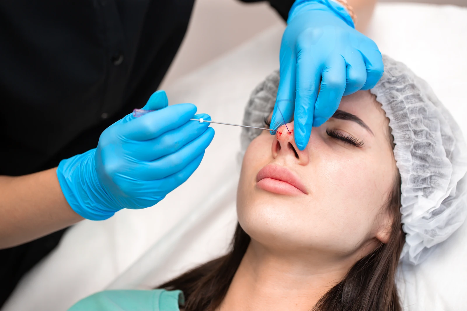 Tip Rhinoplasty