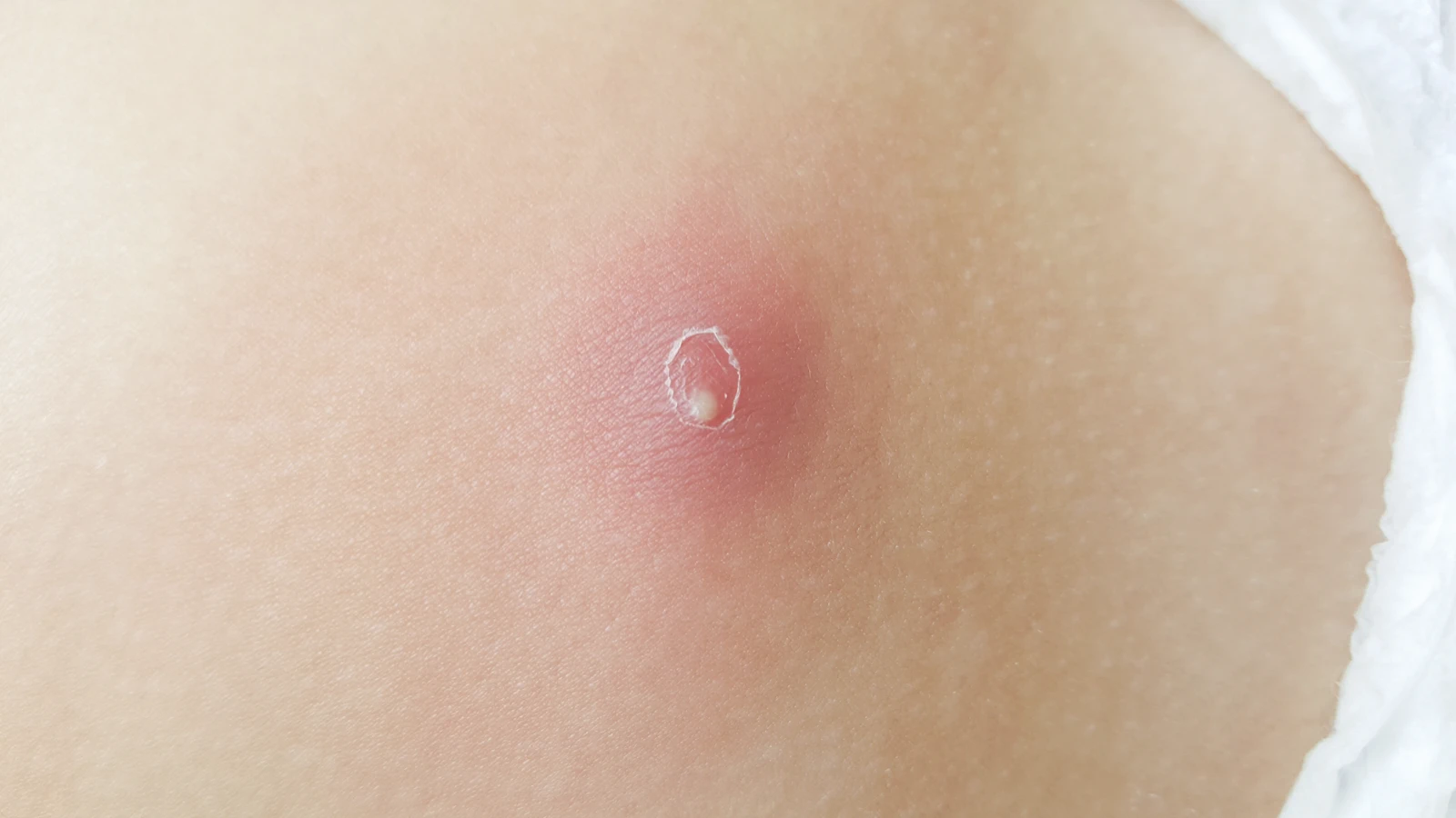 Abscess Drainage