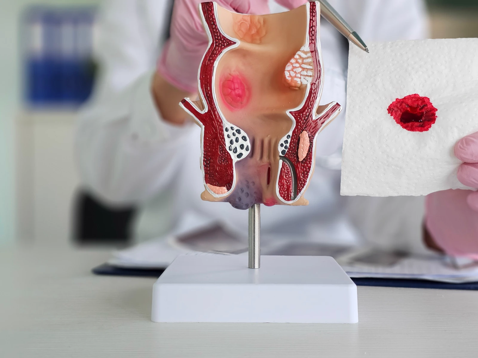 Haemorrhoid & Anal Disease Evaluation