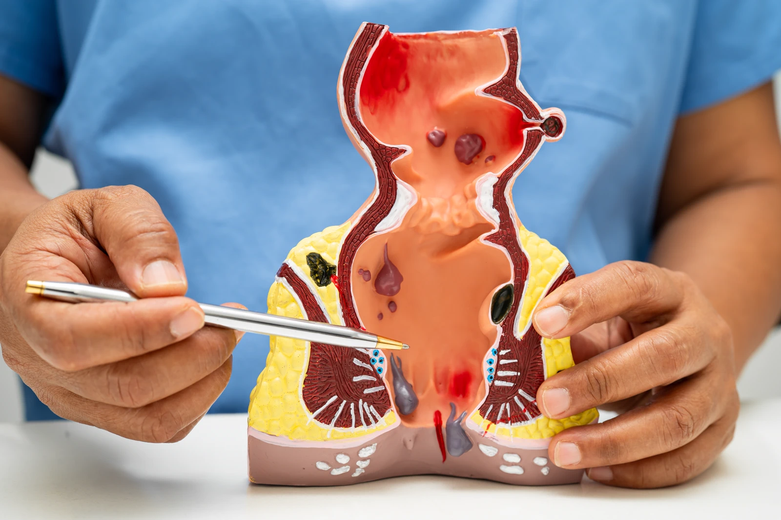 Anal Fissure Surgery
