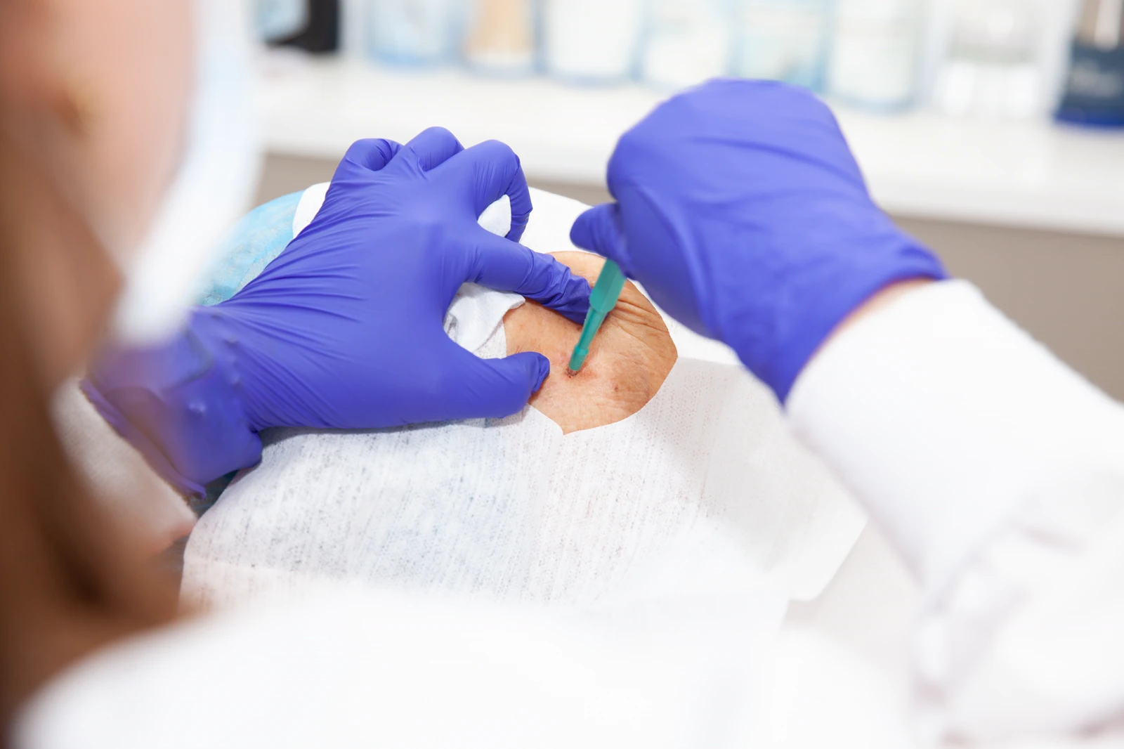 Breast Mass Excision / Biopsy