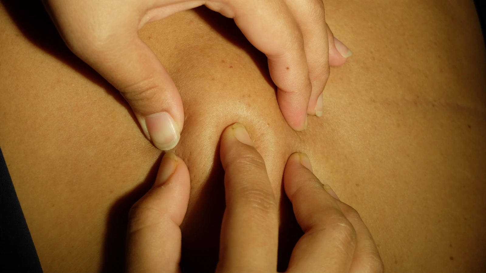 Lipoma Removal