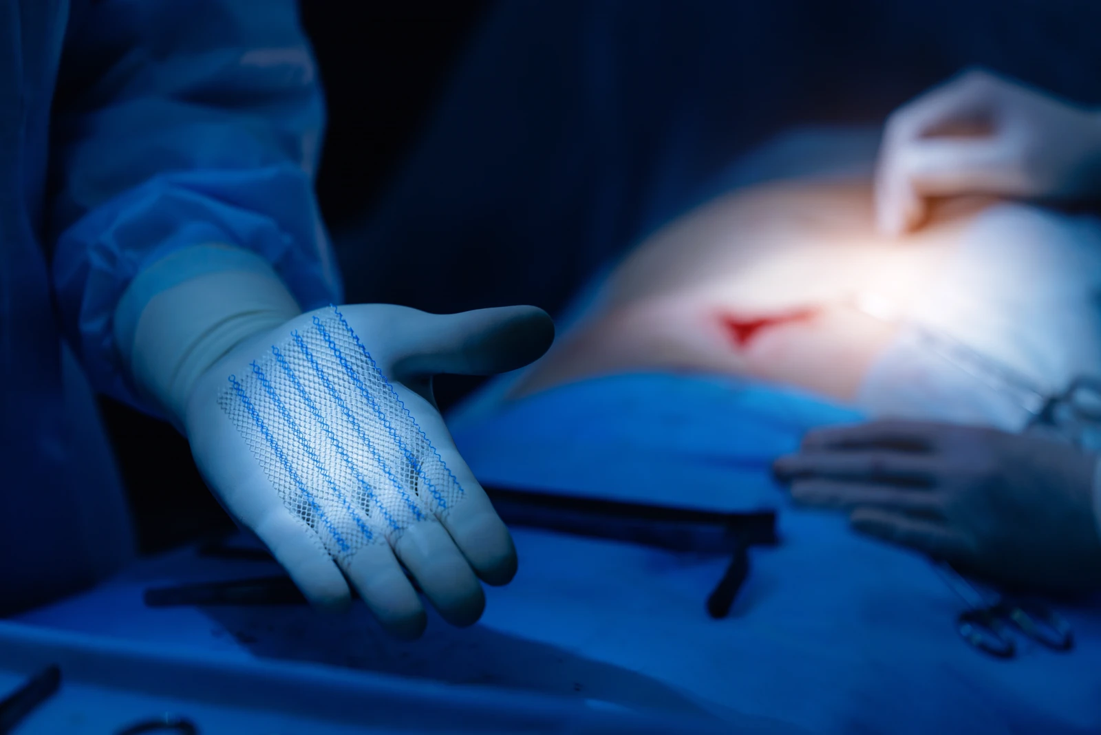Umbilical Hernia Surgery