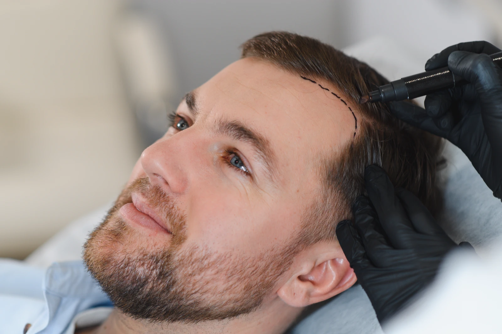 FUE hair transplant