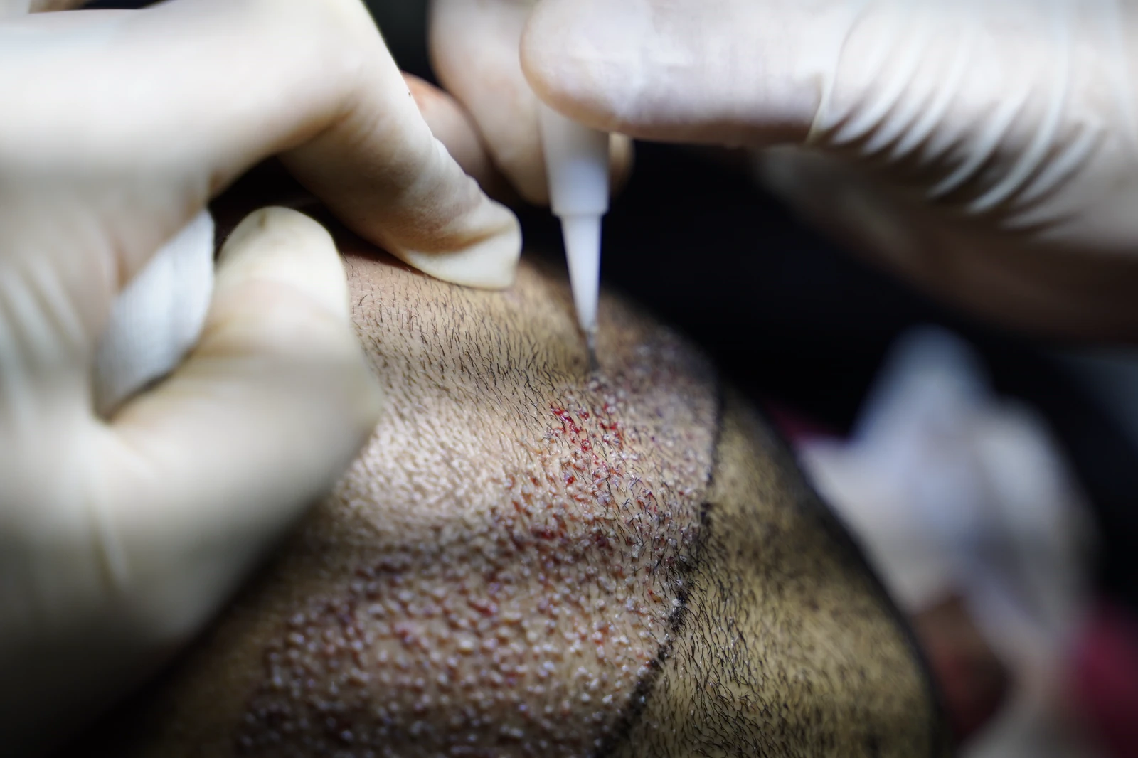 Hybrid Hair Transplant