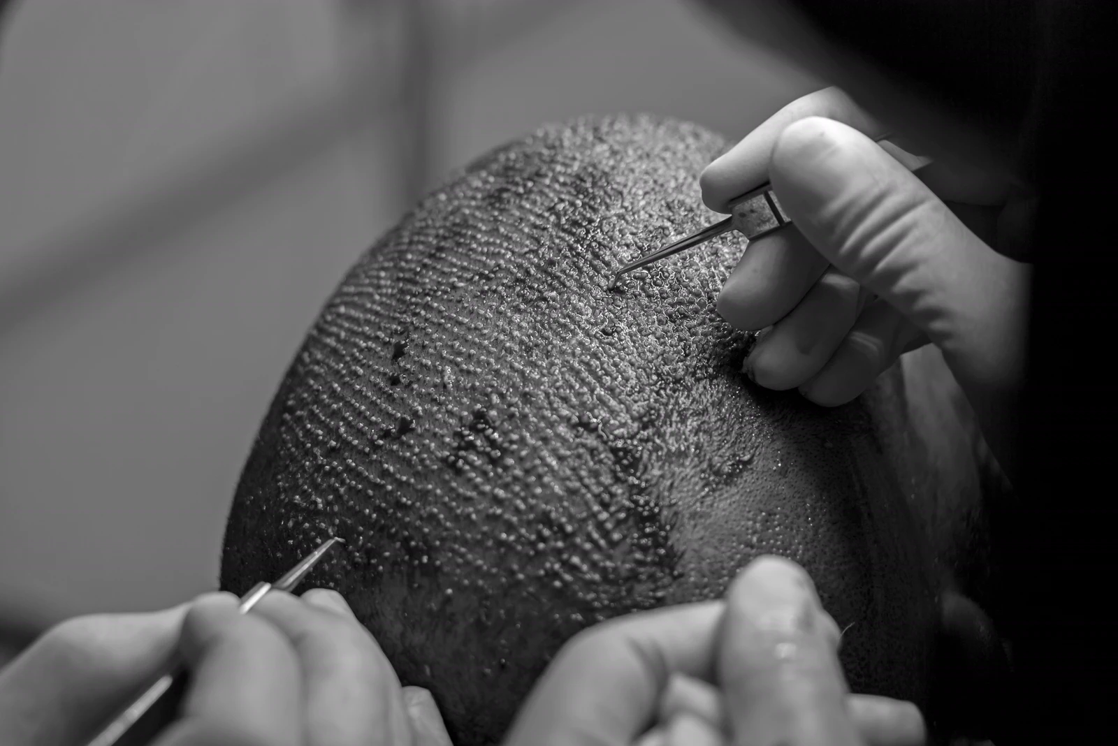 Sapphire FUE Hair Transplant