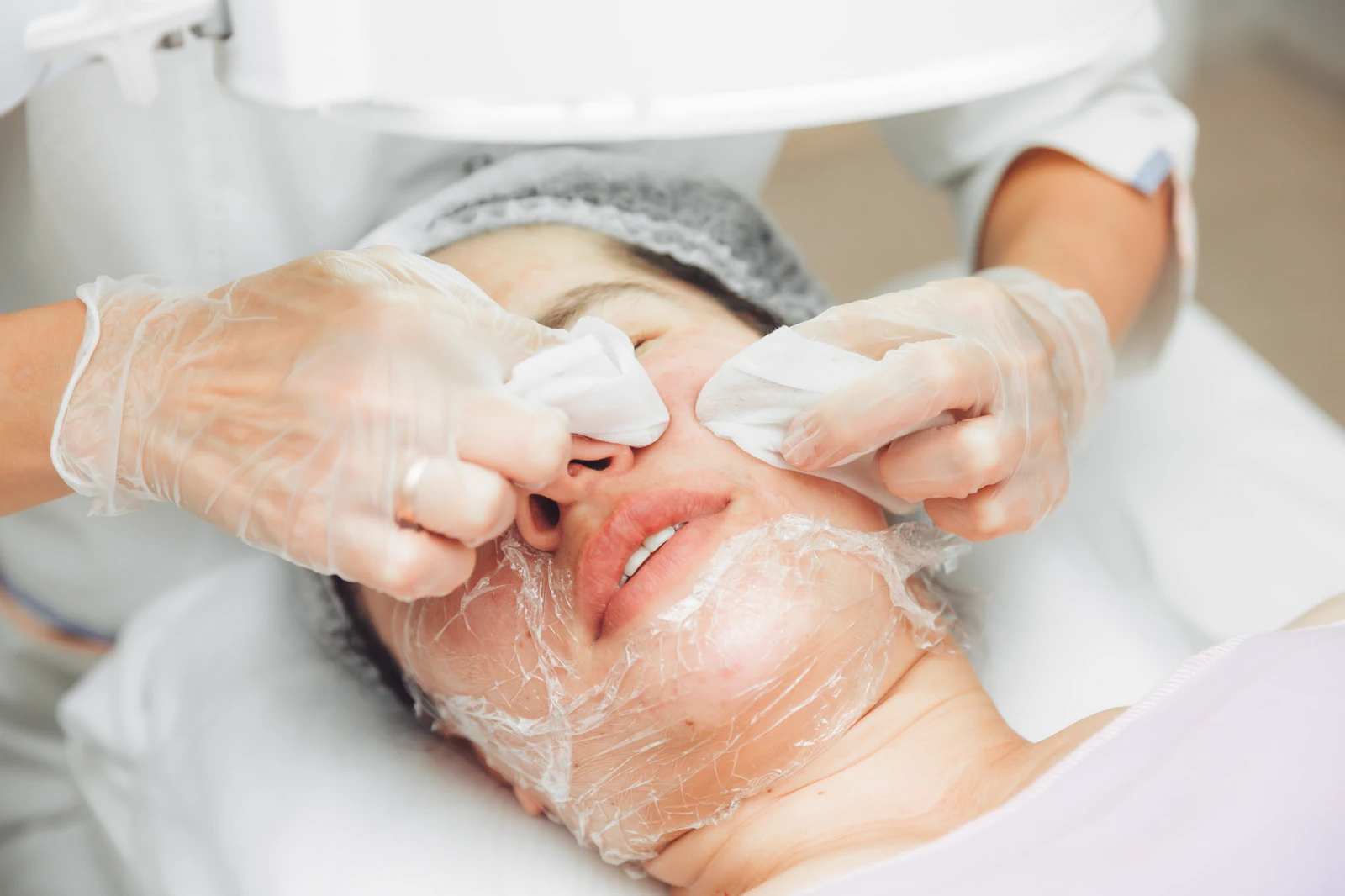 Acne Treatment