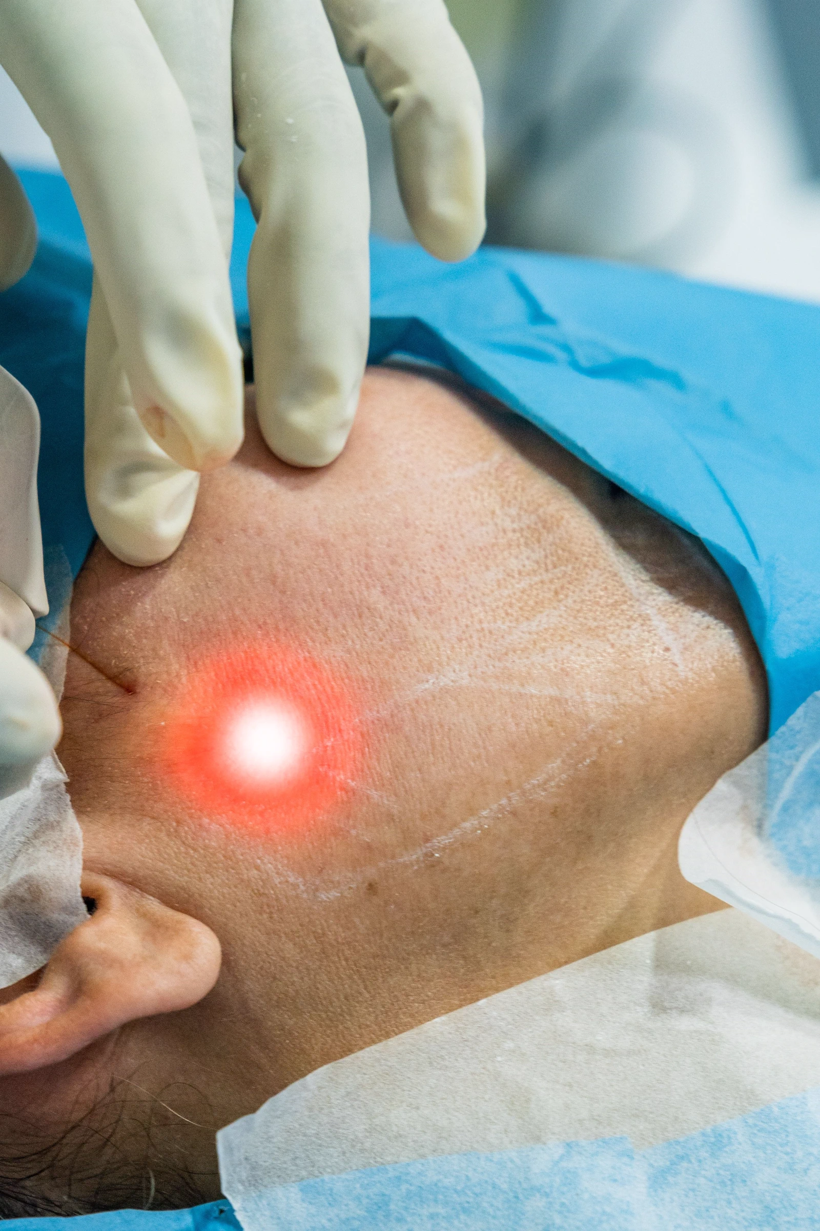 Endolift