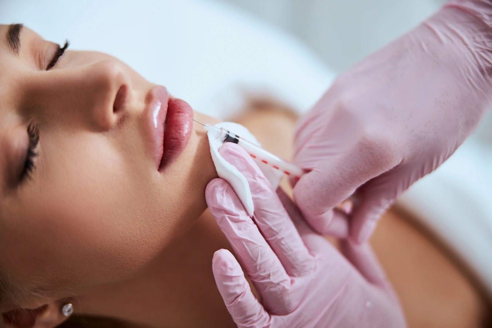 Lip Filler