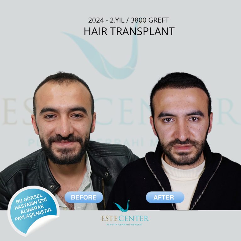 SaçEkimi_04