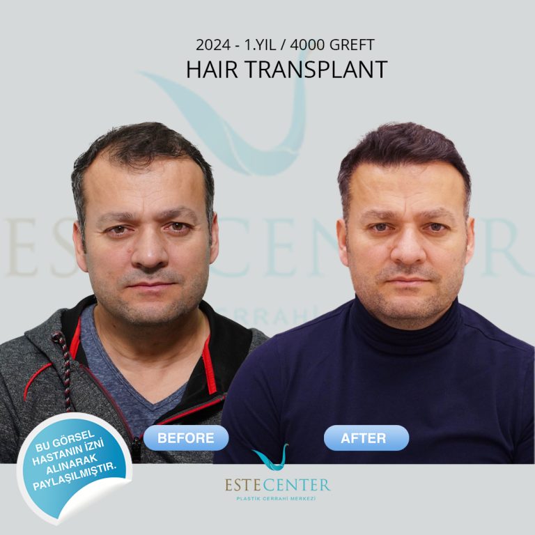SaçEkimi_06