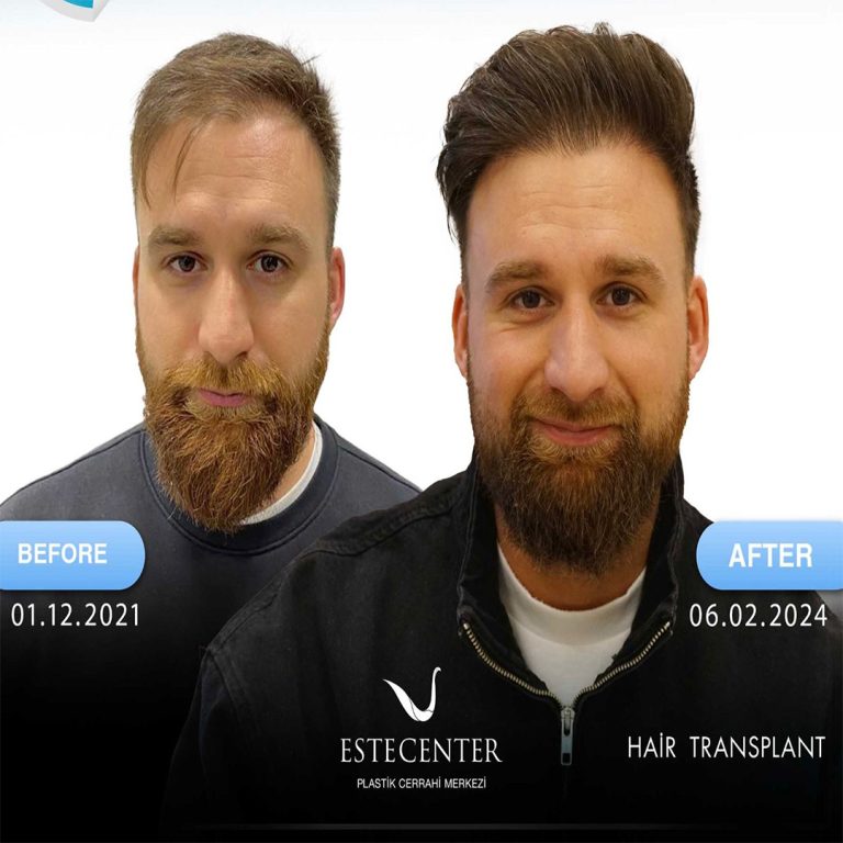 before-after